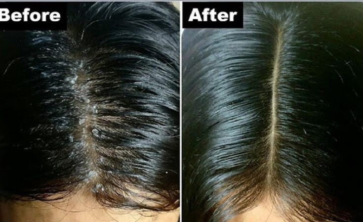 Organic Dandruff Shampoo شامبو معالجة القشرة العضوي