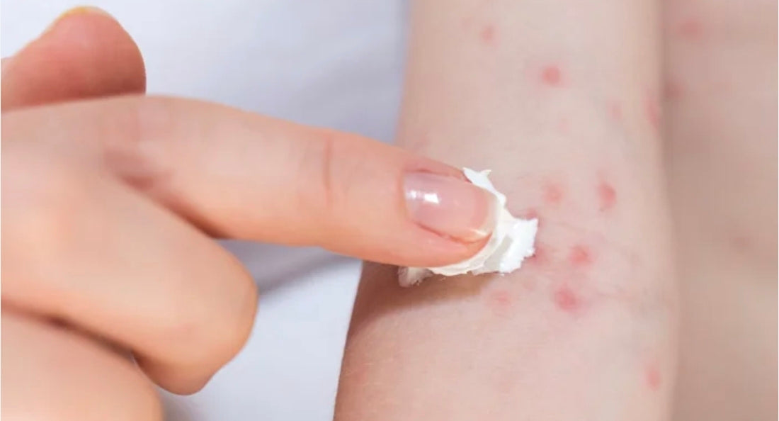 Allergy Organic Cream كريم معالجة الحساسية العضوي