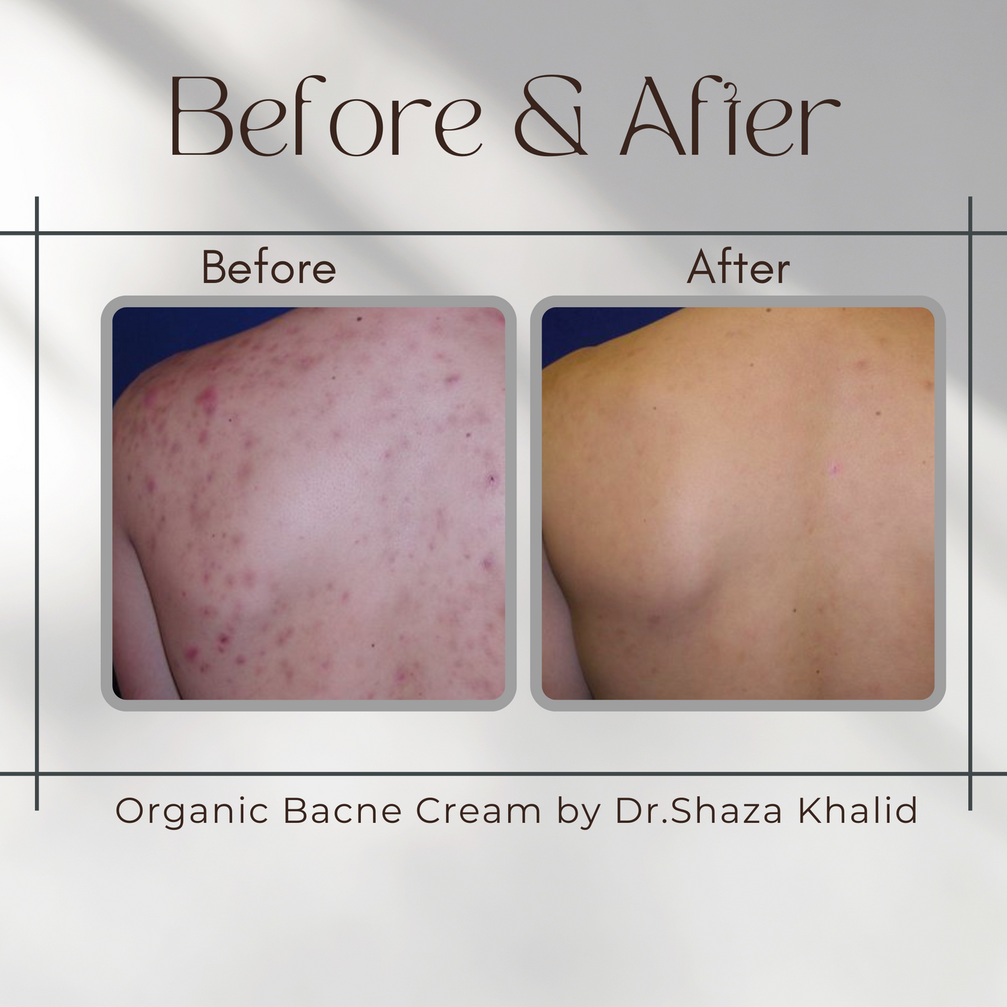 Organic Bacne Cream by Dr.Shaza Khalid