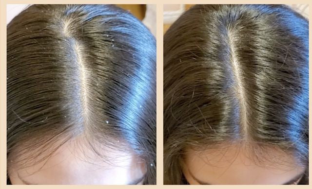 Organic Dandruff Shampoo شامبو معالجة القشرة العضوي