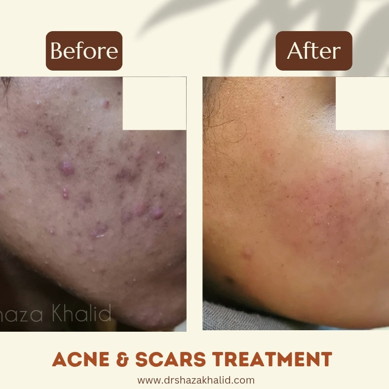 Organic Acne cream by Dr.Shaza Khalid تركيبة الأكني