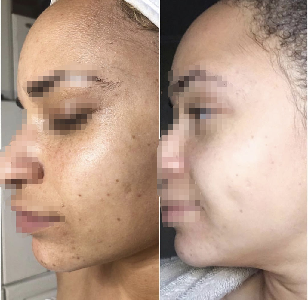 Organic Biopeel التقشير العضوي للبشرة