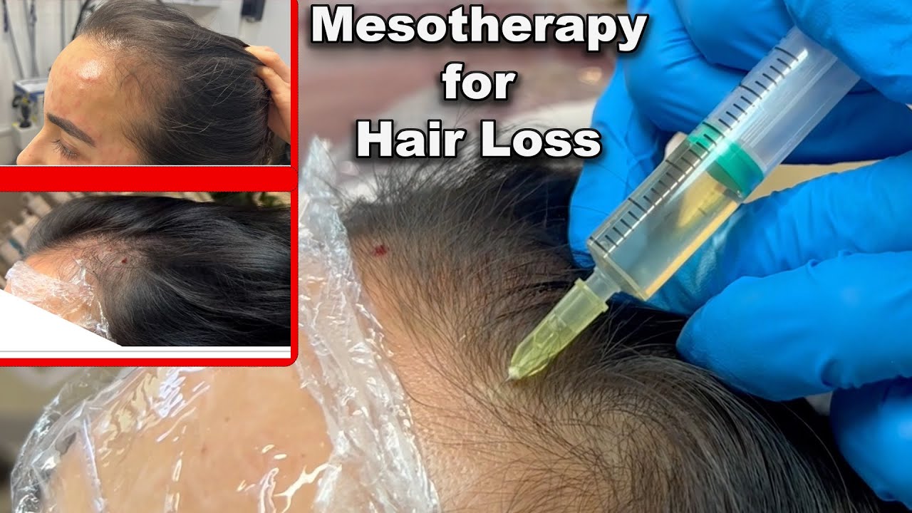 Hair Mesotherapy