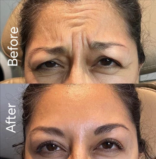 Botox